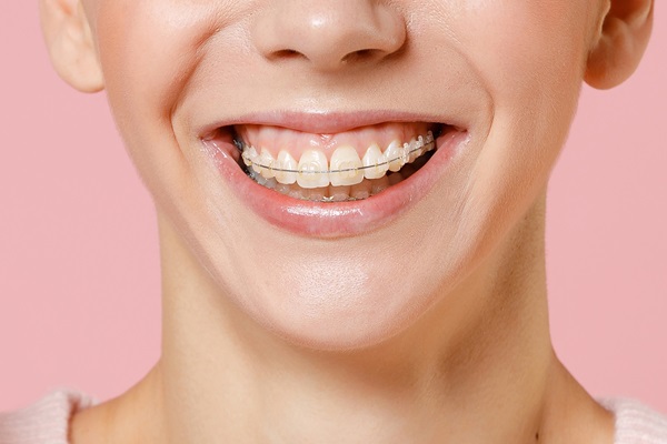 Adult Braces: What Are Your Options?