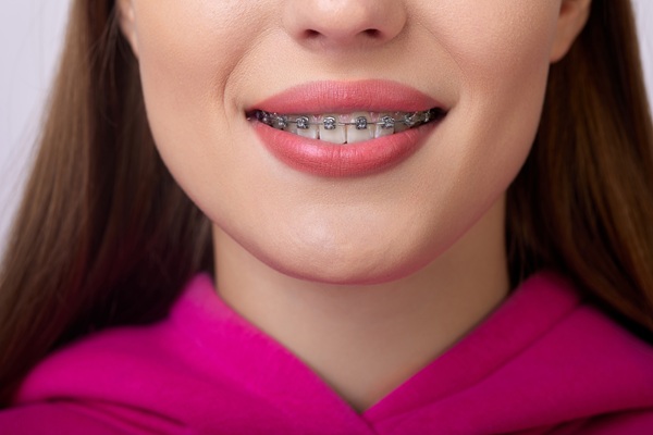 Popular Types Of Braces Near Me